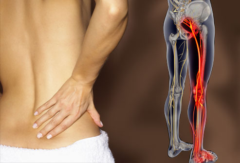 Contro la sciatica il bisturi non serve